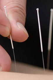 Acupuncture Therapy For Neurological Conditions